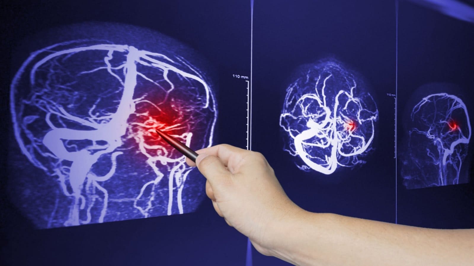 Doctor pointing a brain scan result