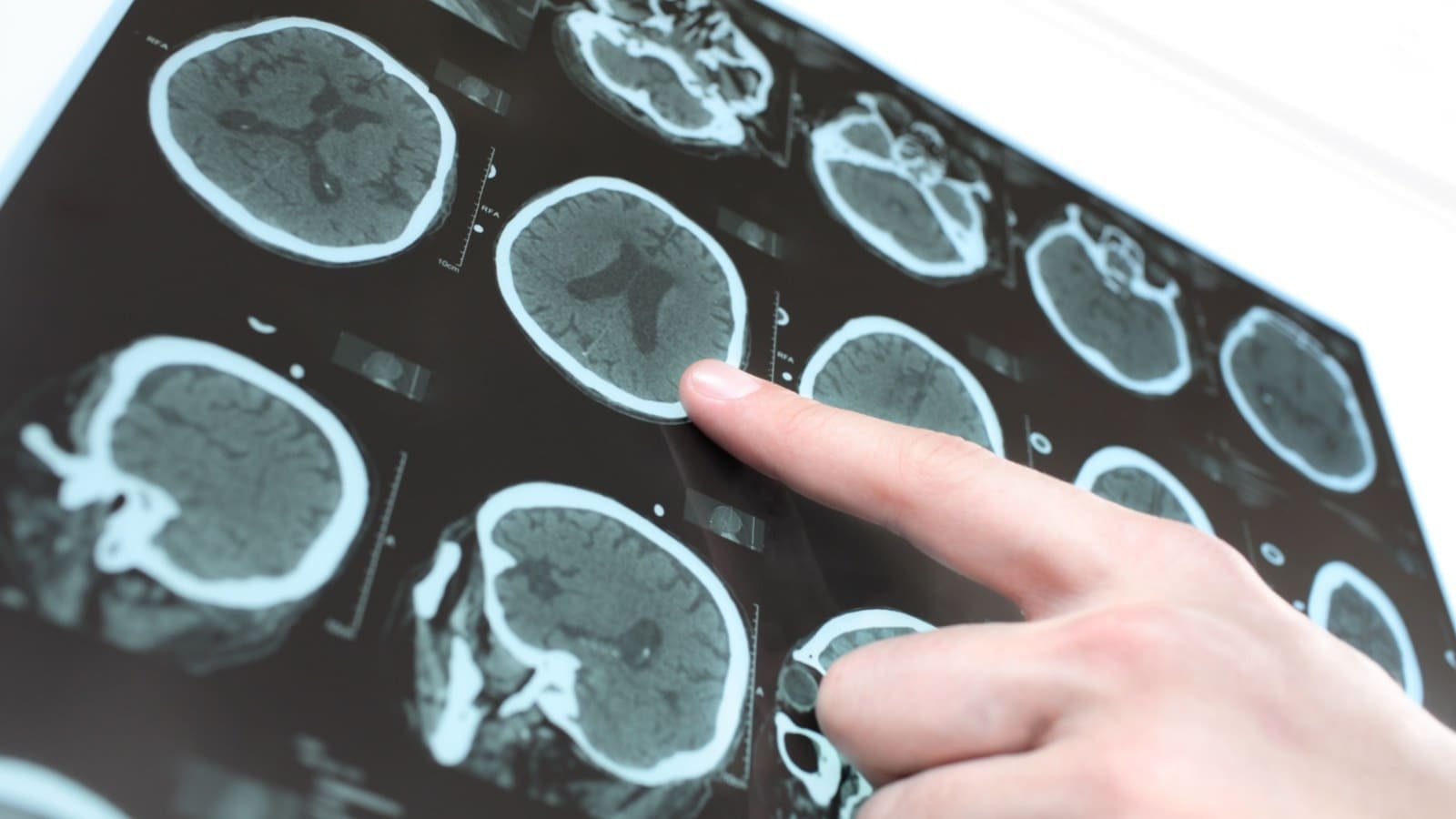 Hand pointing to a CT scan result